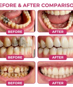 Insideefy® Cavity-Repair Natural Enamel Filling Gel