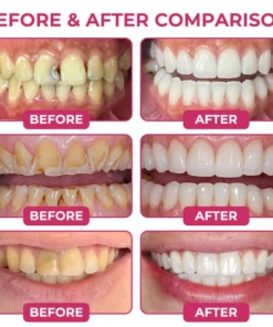 Insideefy® Cavity-Repair Natural Enamel Filling Gel